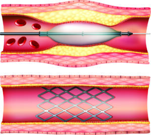 angioplasty near me